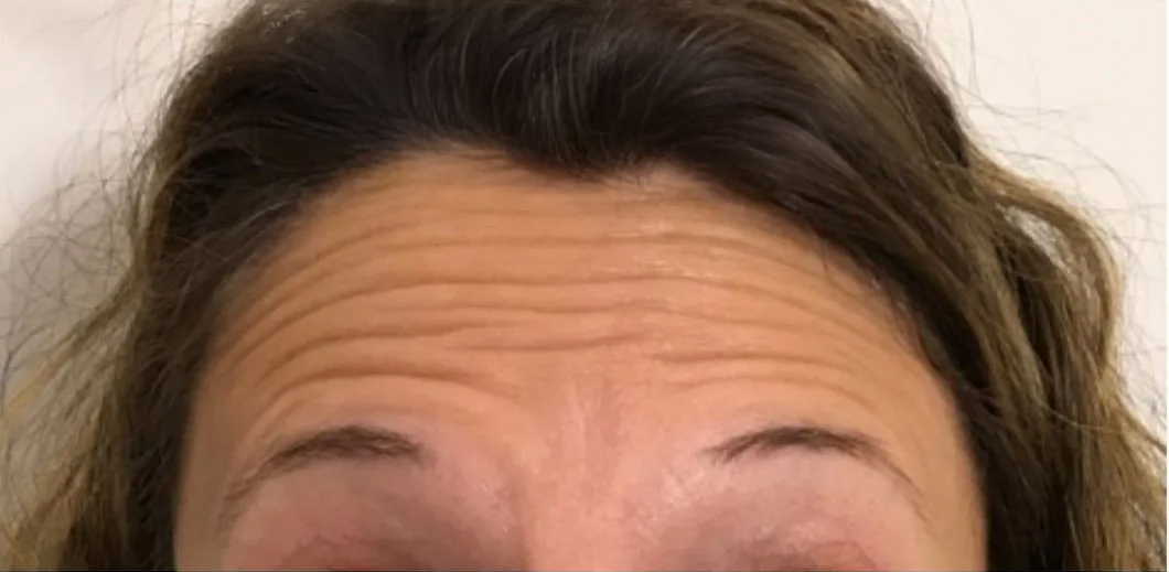 Close-up of a person's forehead with visible wrinkles.