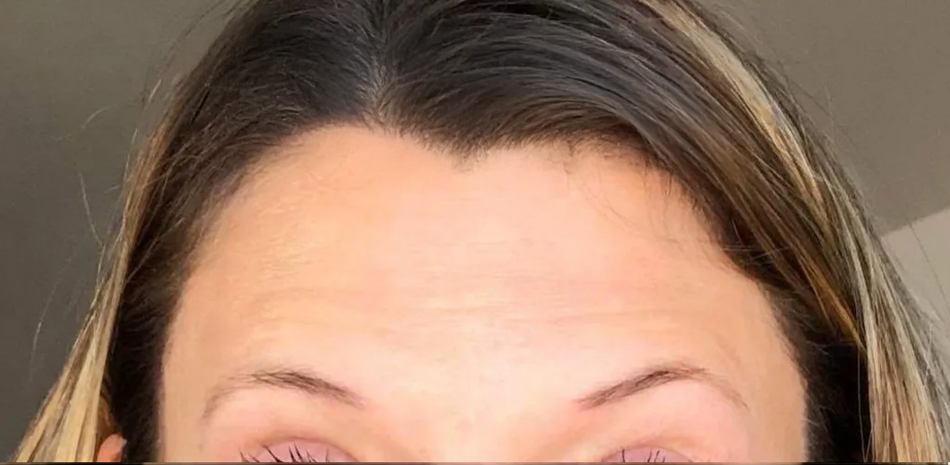 Close-up of a person's forehead and hairline.