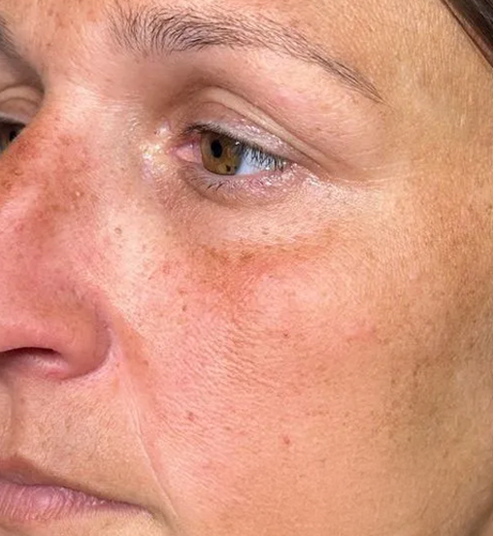 Close-up of a woman's face showing natural skin texture and freckles.