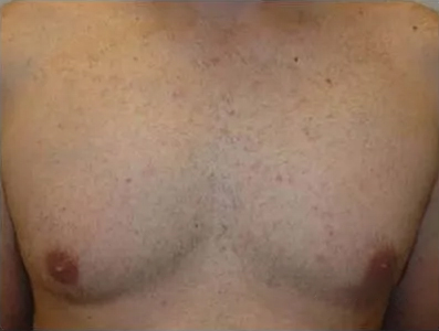 Close-up of a man's bare chest showing skin texture and nipples.