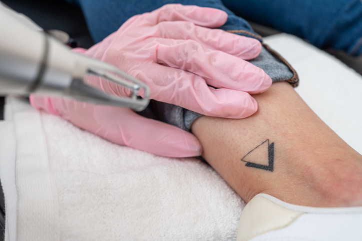Laser tattoo removal on ankle with pink-gloved technician, geometric triangle design.