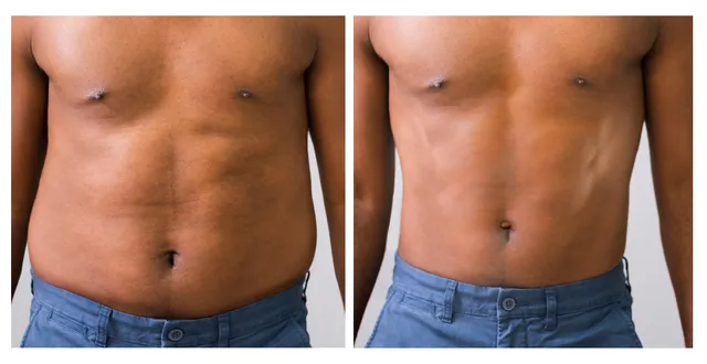 Before and after view showing visible reduction in abdominal fat.