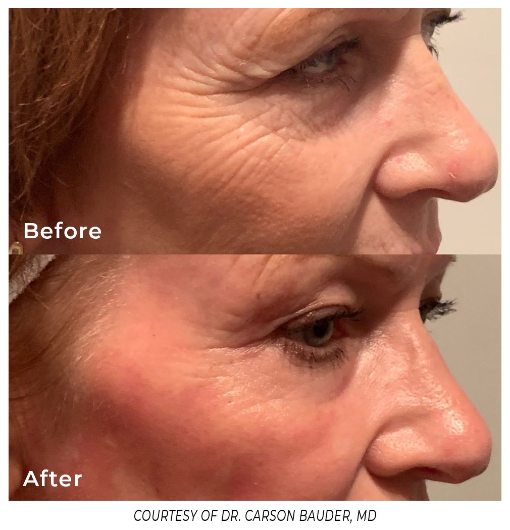 Before and after images of a woman's facial treatment, highlighting reduced wrinkles.
