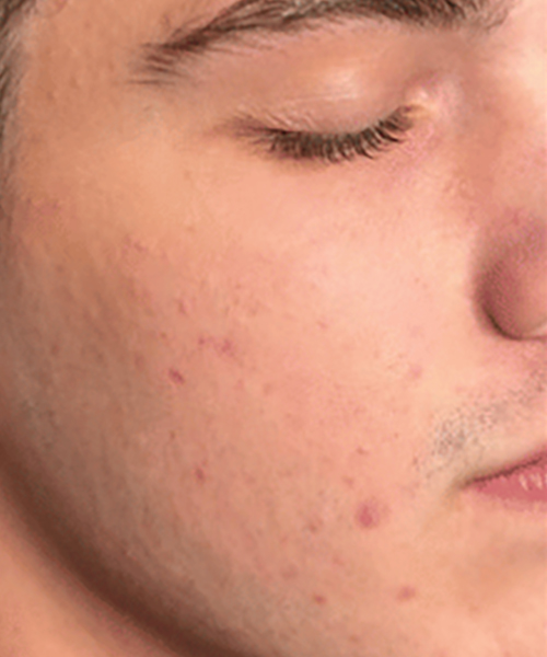 Close-up of a person's face with visible acne and closed eyes.