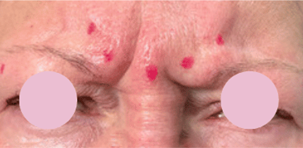 Red spots on forehead skin of an individual.