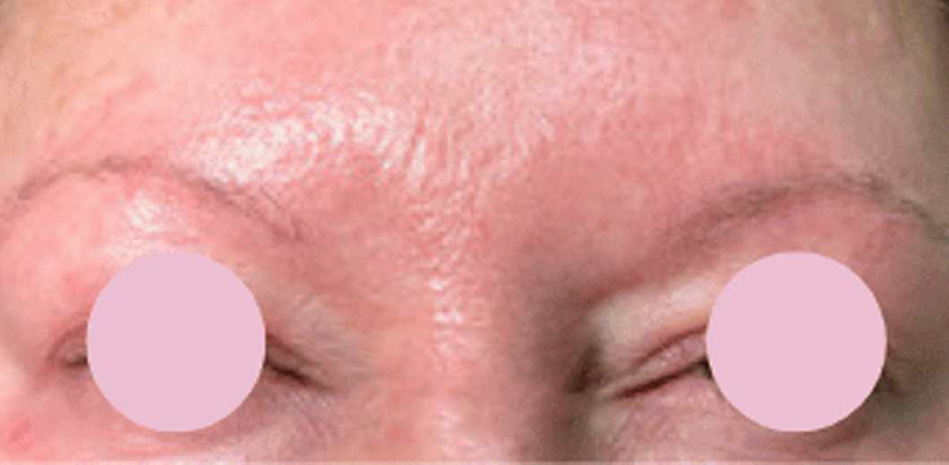 Close-up of a person's forehead and eyes with circles covering the eyes.