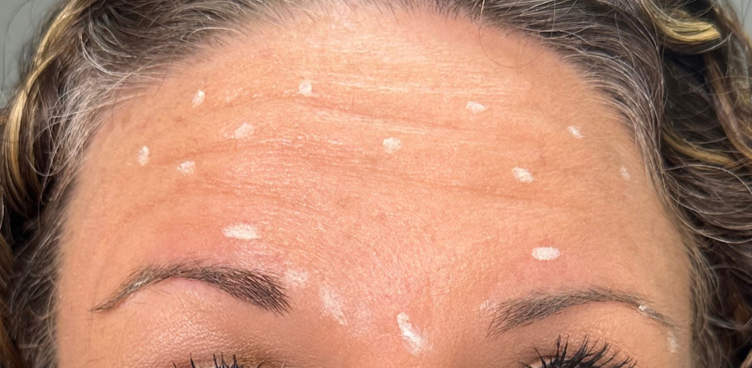 Forehead marked with white dots for cosmetic treatment.