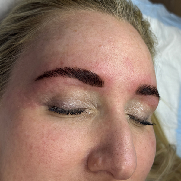 Close-up of a woman's face with freshly tattooed eyebrows.