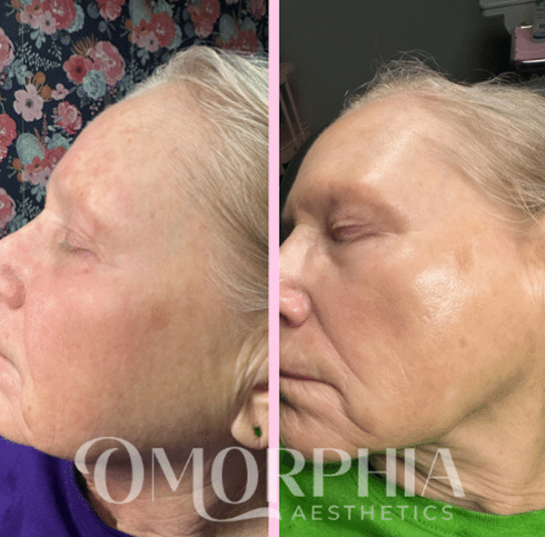 Before and after skincare treatment comparison of a woman's profile.