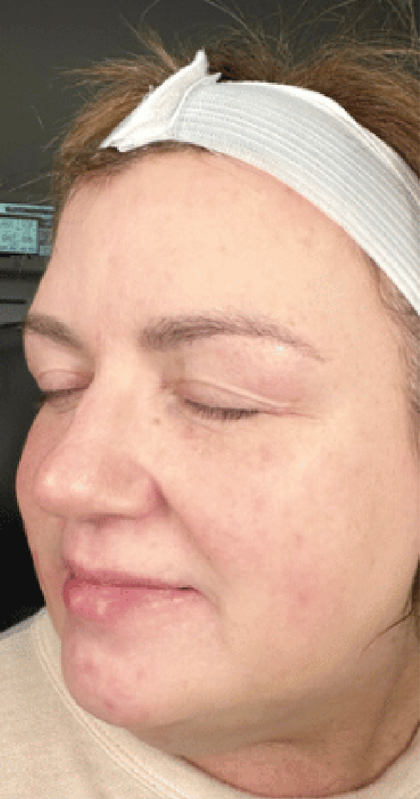 A woman with a headband and closed eyes showing clear skin.