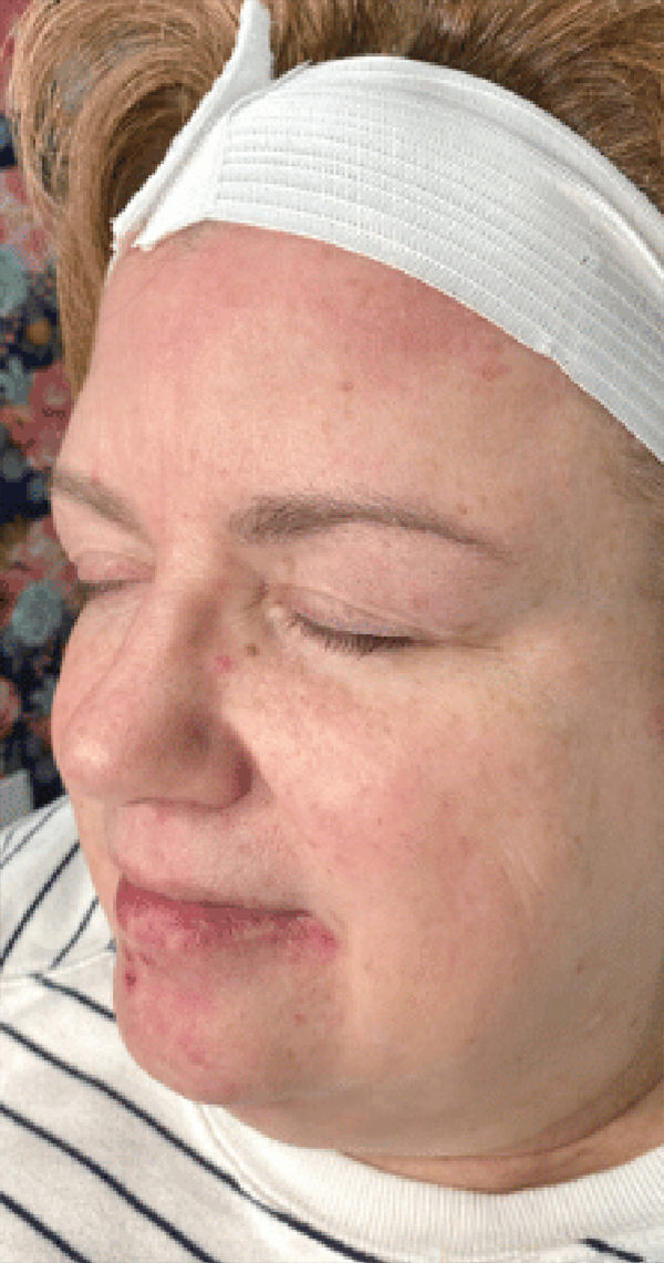 A person with a white headband and closed eyes showing facial redness.