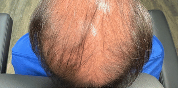 Top view of a person with thinning hair sitting in a chair.