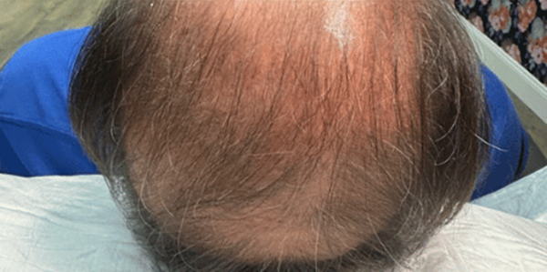 Top view of a man's thinning hair, showcasing hair loss pattern.