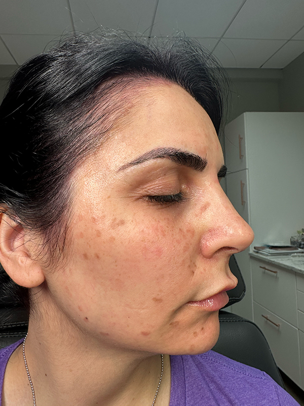 Close-up of a woman's face with acne scars in a clinic setting.
