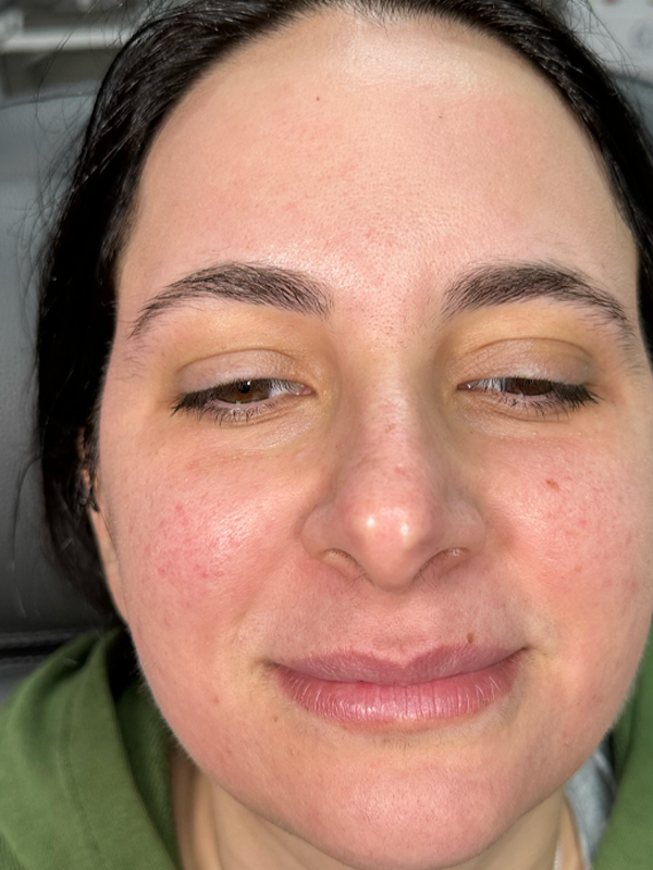 Close-up of a woman's face with slight redness and clear complexion.