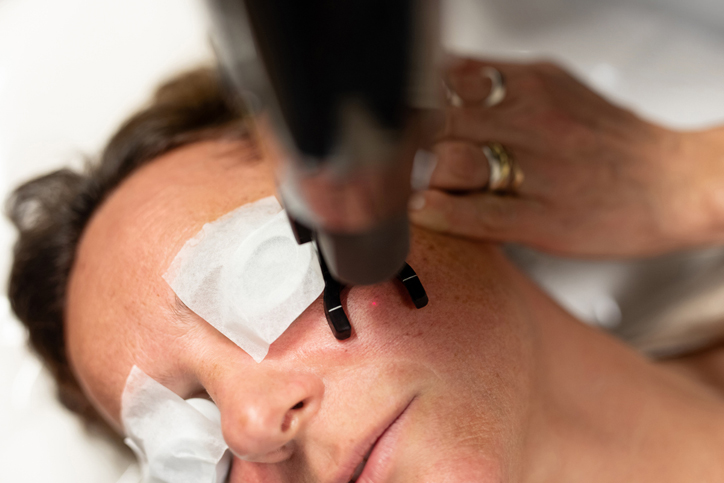 Woman receiving facial laser treatment, eye protection applied.