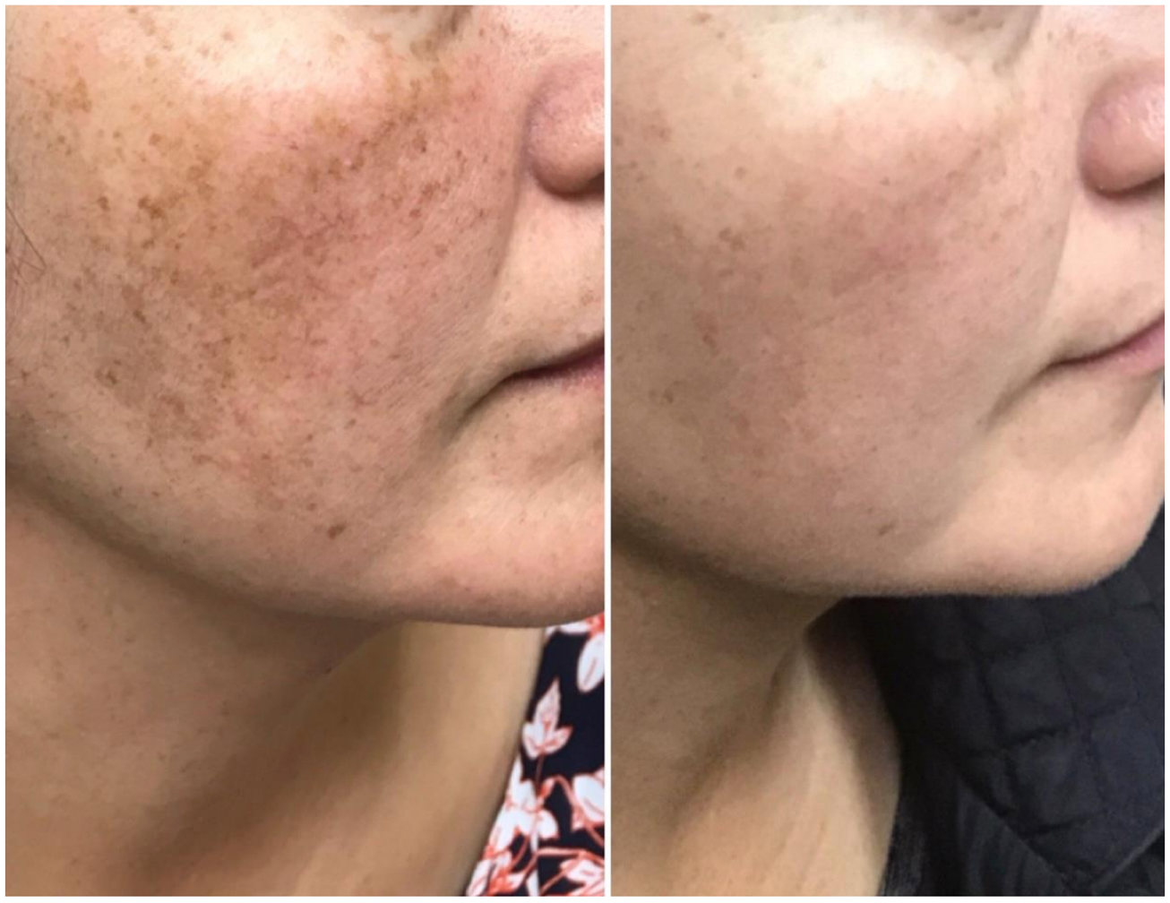 Before and after skin treatment showing reduced brown spots on a woman's cheek.